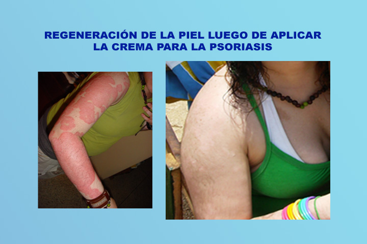 El tratamiento atopicheskogo de la dermatitis en irkutske